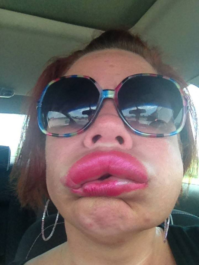 Only dumb people pay money for expensive collagen lip filler injections. Because they can get one for free from bees!